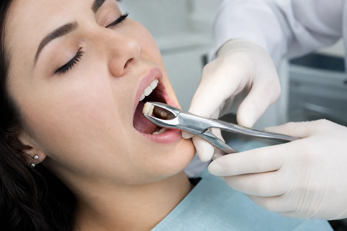 Wisdom Tooth Removal